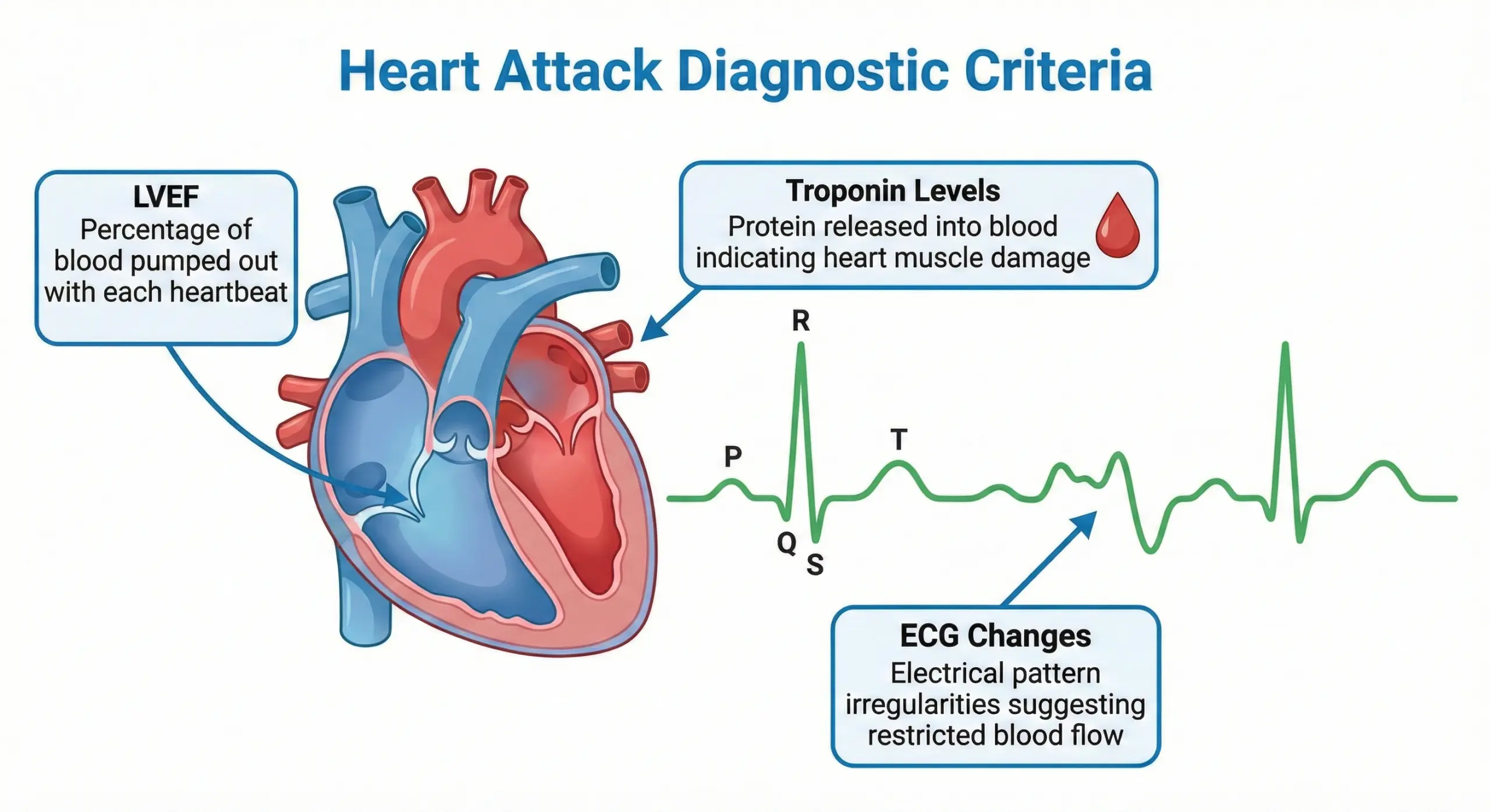 Infographic explaining the medical criteria for a heart attack trauma claim, including troponin levels, ECG changes, and LVEF.